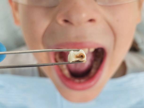 Best Emergency Tooth Extraction in Cera, AL